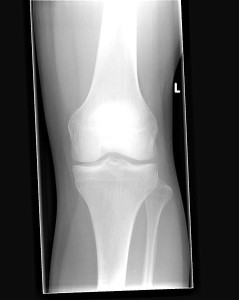 478px-Knee_Front_X-ray