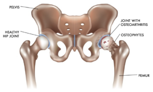 Hip in need of Total Hip Replacement