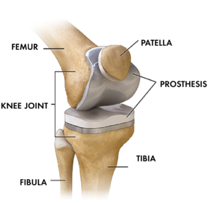 Total Knee Replacement Prosthesis