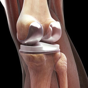 anatomy around total knee replacement prosthesis