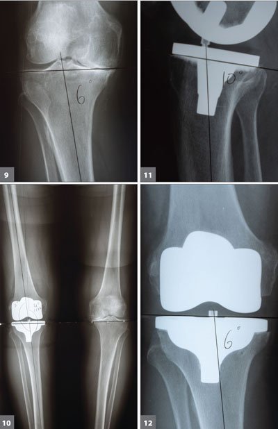 radiographs of a kinematic alignment TKR implant